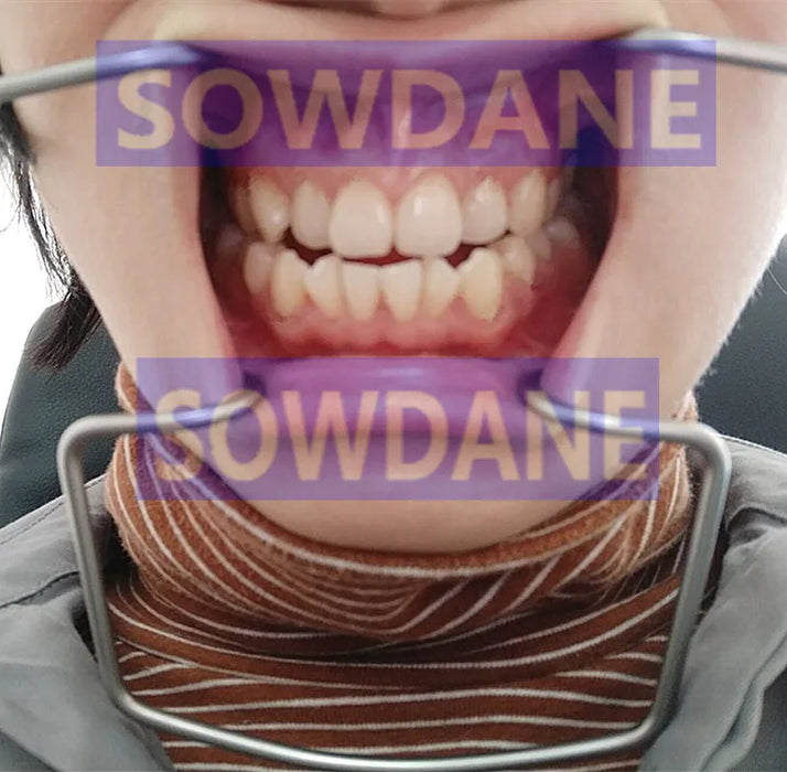 1 pezzo impianto dentale divaricatore labbra e guance strumento ortodontico chirurgico apri bocca autoclavabile in acciaio inossidabile